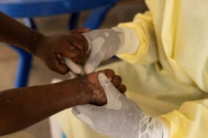 Lire la suite à propos de l’article MPox : Le Professeur Moussa Seydi annonce la fin de l’hospitalisation des derniers patients
