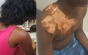 Drame conjugal à Yeumbeul : un homme ébouillanté par sa femme