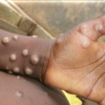 Lire la suite à propos de l’article Mpox : l’Angola recense 442 cas et deux décès dans 11 provinces