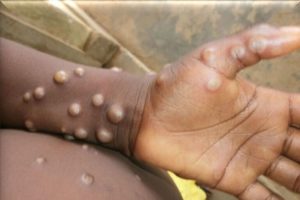 Lire la suite à propos de l’article Mpox : l’Angola recense 442 cas et deux décès dans 11 provinces