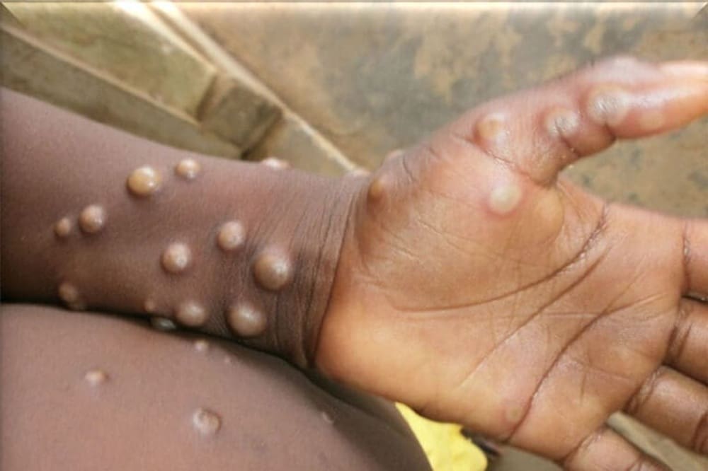 You are currently viewing Mpox : l’Angola recense 442 cas et deux décès dans 11 provinces
